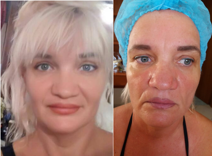 Facial rejuvenation in the cosmetology studio of Lyudmila Grushko. Sign up for a discount