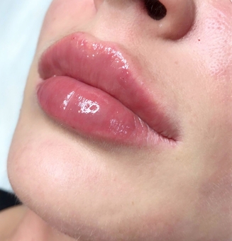 Косметологічний кабінет Олени Кузьменко в Києві. пластика губ зі знижкою.