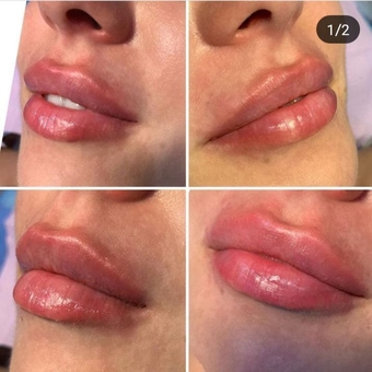 Косметологічний кабінет Олени Кузьменко в Києві. поліпшення форми губ акцією.